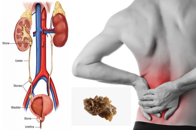 facts about kidney stones