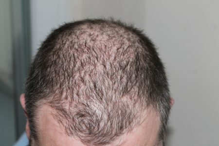 Medical Issues That Can Lead to Permanent Hair Loss