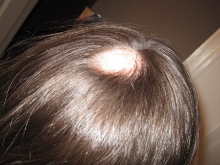 Hair loss – (alopecia)