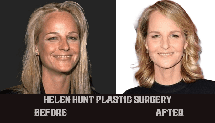 Helen Hunt Plastic Surgery, Car Crash information 
