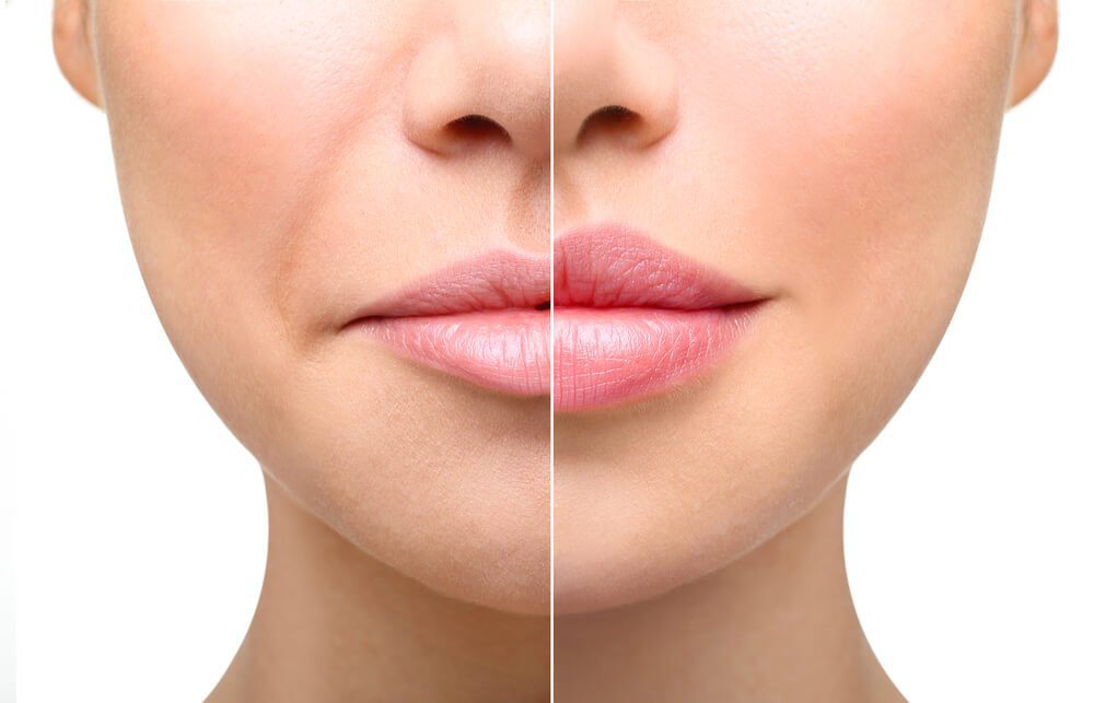 Let’s talk about lip fillers