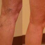 Reviewing sclerotherapy: A non-invasive treatment for varicose veins