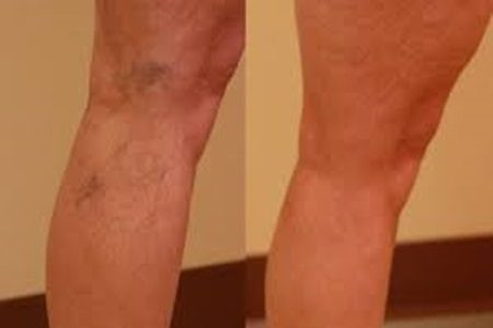 Reviewing sclerotherapy: A non-invasive treatment for varicose veins