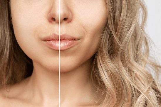 What you Need to Know about Buccal Fat Removal