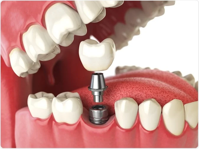 Cost of Dental Implants: