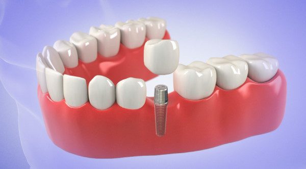 Tooth Implant expenses in LA