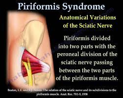 4 Causes of Piriformis Syndrome