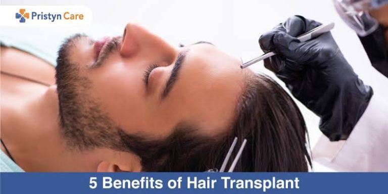 Benefits of Hair Transplant