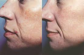3. Improve acne scars