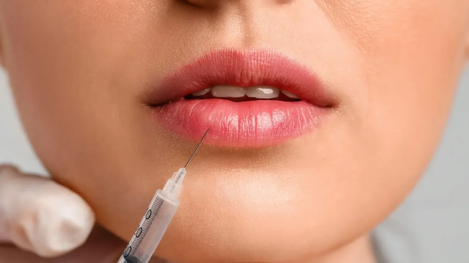 lip fillers