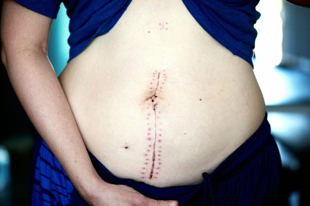 gastric sleeve surgery